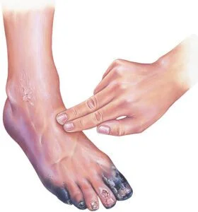 Gangrene Treatment
